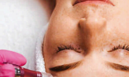 Dermapen: el aliado perfecto para una piel impecable